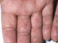 Picture of <b>Dyshidrotic Eczema</b>: