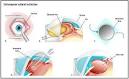 <b>cataract extraction</b>,