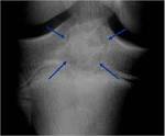 <b>Chondroblastoma</b> : Bone Cancer