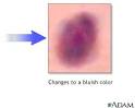 Bruise :: Nationwide Children's Hospital