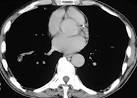 LearningRadiology - Rugger-Jersey Spine, Hyperparathyroidism