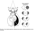 <b>Enfermedades</b> del <b>nervio óptico</b>