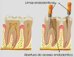 Processo de desvitalização