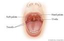 Normal and cleft <b>palate</b>