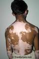 Vitiligo Universal vitiligo vitiligo treatment vitiligo cure