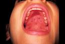 Hand-Foot-and-Mouth Disease in Mouth Picture Image on MedicineNet.