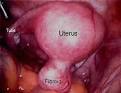 Fibroid Tumors In The Uterus, Fertility and Infertility
