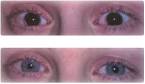 <b>Aniridia</b> – a disorder where