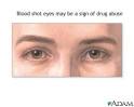 Drug Signs and Teenagers :: Nationwide Children's Hospital