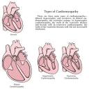 cardiomyopathy
