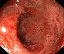 sår vid Crohns <b>sjukdom</b>.