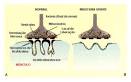<b>Doenças Neuromusculares</b>
