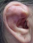 Pictures of Chondroma of the Auricle * OTOLARYNGOLOGY HOUSTON