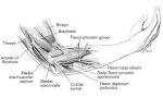 Often, the <b>nerve entrapment</b>