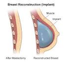 Breast Reconstruction | Health Library | Weill Cornell Physicians ...