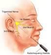 Relief of the <b>neuralgia</b> by