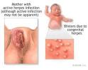 Herpes Simplex - In-Depth Report - NY Times Health