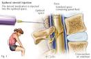 Epidural Steroid Injection