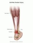 Achilles <b>Tendon Injury</b>