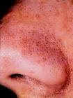Blackhead Extractor Blackhead No More