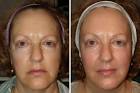 Adam Scheiner, MD Laser Eyelid & Facial Plastic Surgery — Adam Scheiner MD - bierce-peggy-resize3
