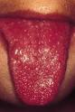 Case study: Recurrent KAWASAKI DISEASE : Article : British Dental ...