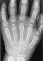 <b>Juvenile Rheumatoid Arthritis</b>