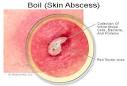 me get rid of my boils