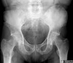 <b>Multiple myeloma</b> .