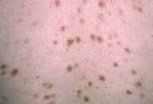 Dermatology Image Atlas: Dermatology Images