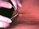 Excision of skin tag