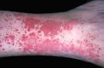 <b>Vasculitis</b> Hypersensitivity