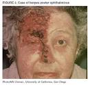 <b>Herpes Zoster</b>