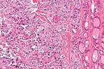 File:<b>Medullary</b> thyroid