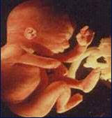 On July 22, 1971, Dr Gennaro Montanino of Rome, Italy, announced he had removed the fetuses ... - fetus