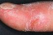 <b>Systemic scleroderma</b>