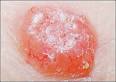 Diagnosis and Treatment of Basal Cell and Squamous Cell Carcinomas ...