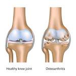 <b>Osteoarthritis</b> is the most