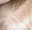 The Truth About Head Lice