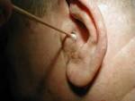 <b>Otitis externa</b>