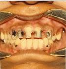 Fluorosis Diagnosis