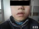 现将舌舔皮炎精彩图片展示如下，