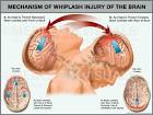 Whiplash