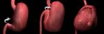 Bloat (gastric dilatation-