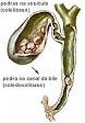 <b>Doenças</b> da <b>Vesícula Biliar</b>