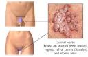 How To Cure Genital Warts Naturally ???? | PRLog