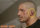James Thompson's Cauliflower Ear (pic) :Five Ounces of Pain