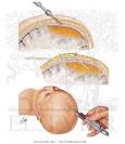 <b>Chronic Subdural Hematoma</b>
