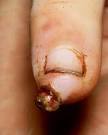 Clinical: pyogenic <b>granuloma</b>