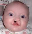 Cause Of Cleft Lip And Palate | Health Guide and Tips